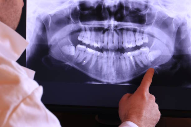Best Emergency Root Canal Treatment in Beecher, MI